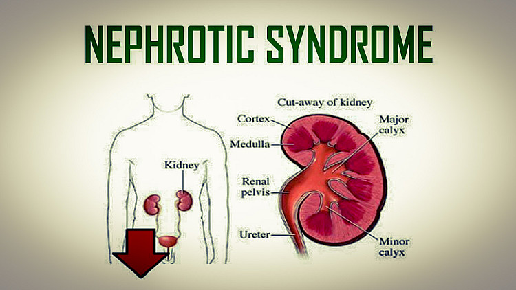 cause of nephrotic syndrome
