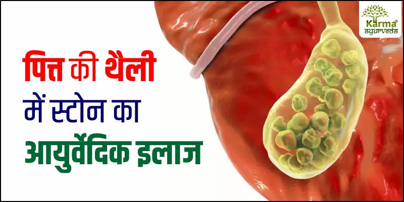 gall-stone-treatment-in-ayurveda