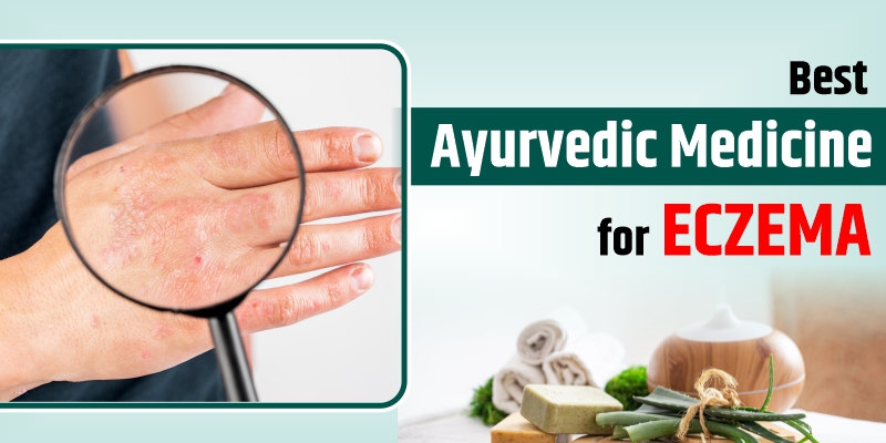 Ayurvedic Medicine for Eczema