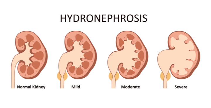 ayurvedic-treatment-for-kidney-hydronephrosis