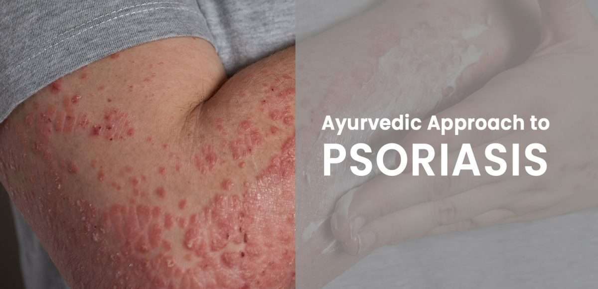 psoriasis-cure-in-ayurvedic