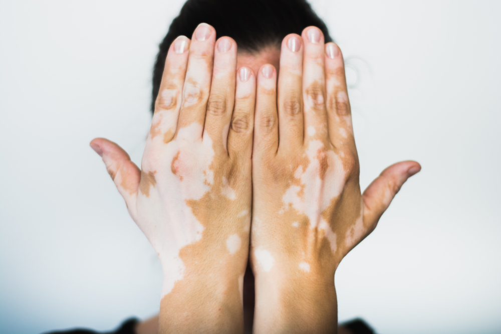 leucoderma-vitiligo-treatment