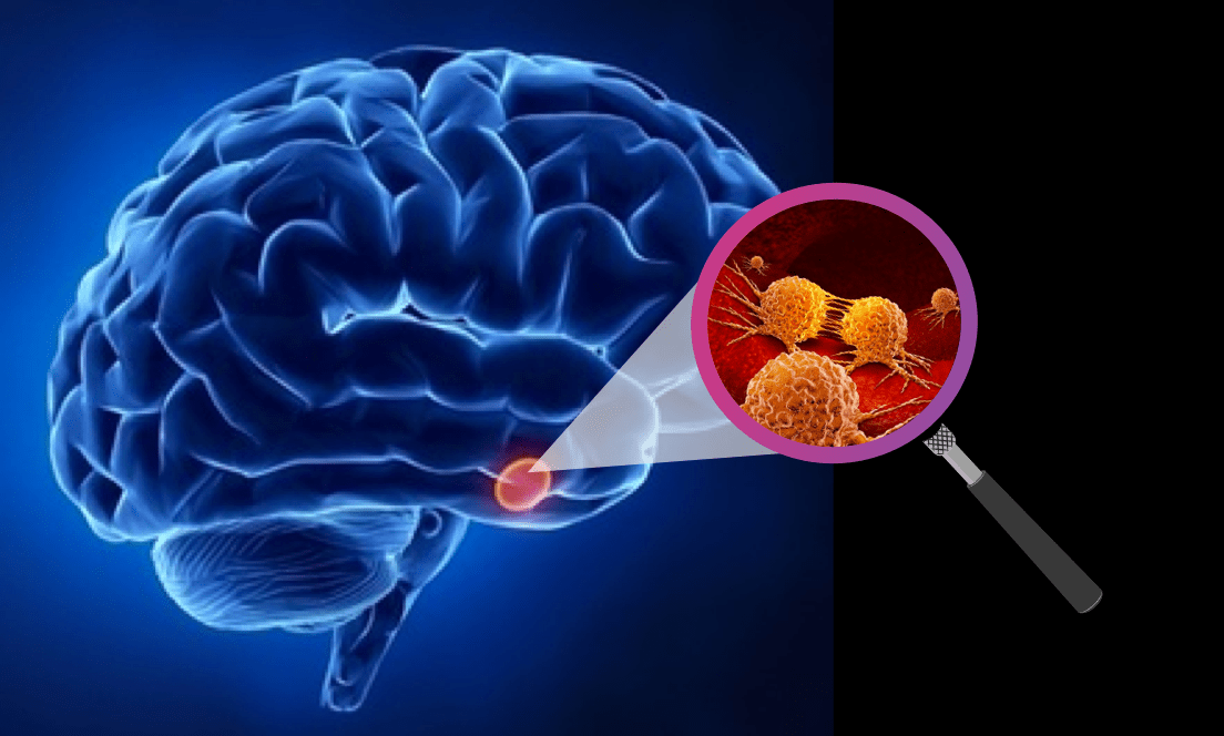 Brain Tumor Treatment in Ayurvedic at Karma Ayurveda