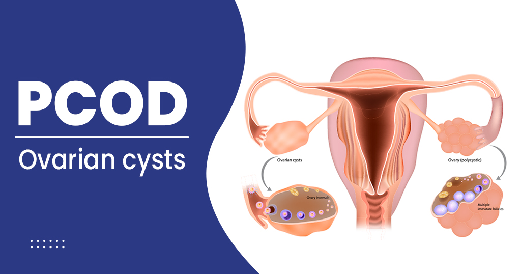 पॉलीसिस्टिक-ओवेरियन-सिंड्रोम-का-आयुर्वेदिक-उपचार