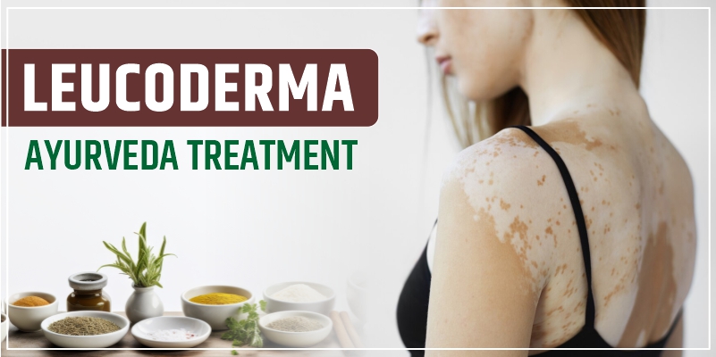 leucoderma-ayurvedic-medicine