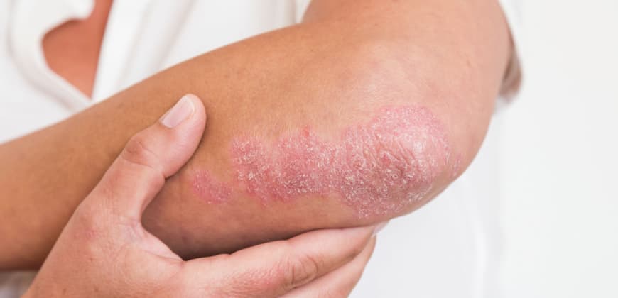 Best Ayurvedic Treatment For Psoriasis