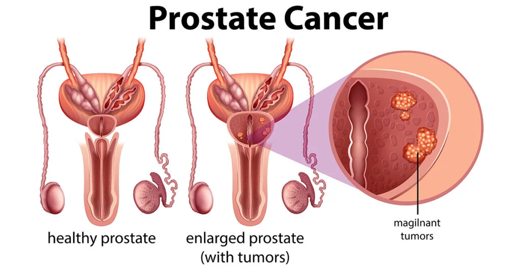 5 Best Prostate Cancer Control Medicines in Ayurveda