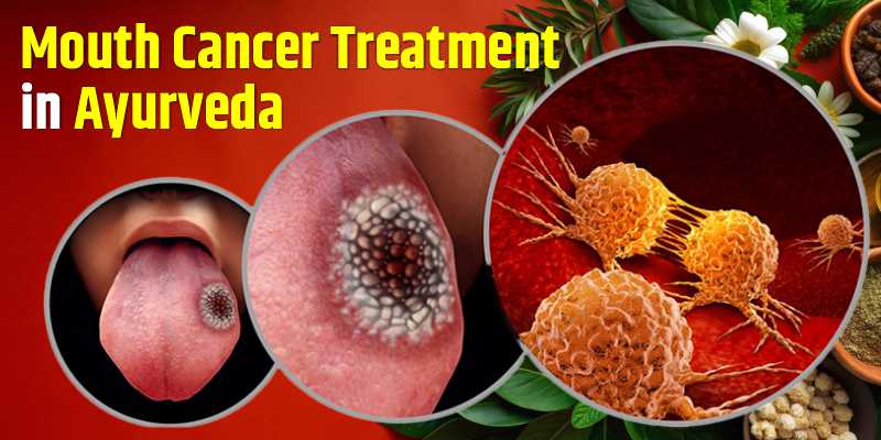 mouth-cancer-treatment-in-ayurveda