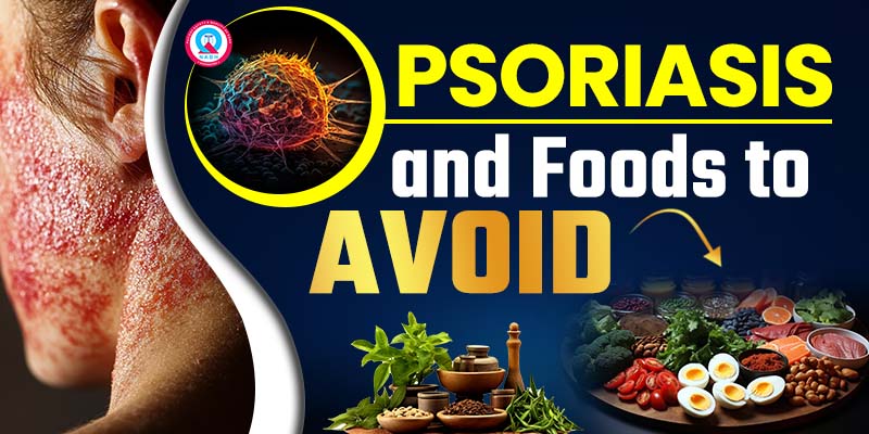 psoriasis-and-foods-to-avoid