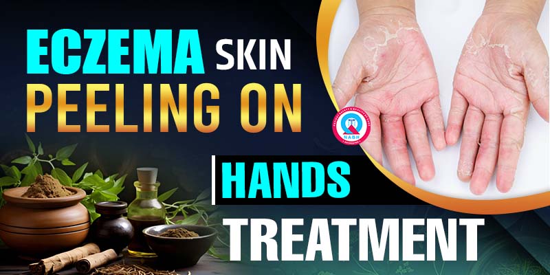 eczema-skin-peeling-on-hands-treatment