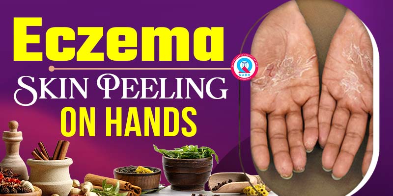 eczema-skin-peeling-on-hands